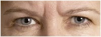 Botox and Dermal Fillers wrinkle removal at Kingswood Clinic in Blackburn 378608 Image 3